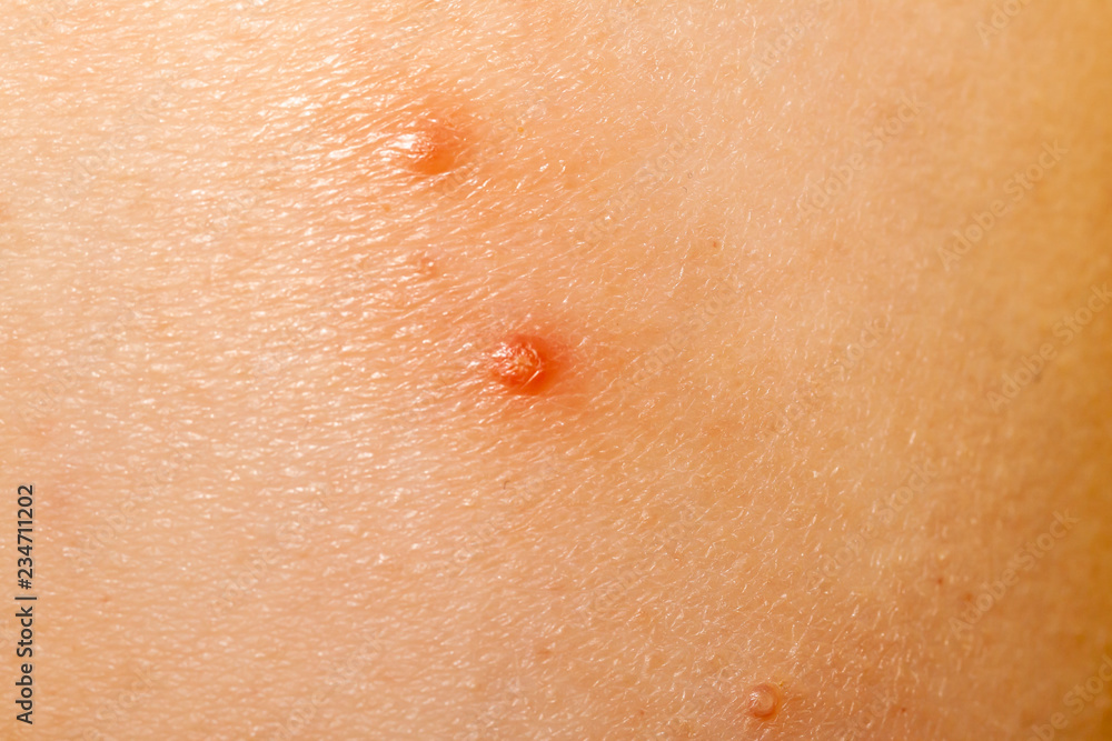 orticaria